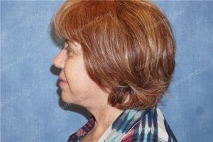 Căng da mặt nữ 68 tuổi người Mỹ - case 14