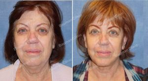 Căng da mặt nữ 68 tuổi người Mỹ - case 14