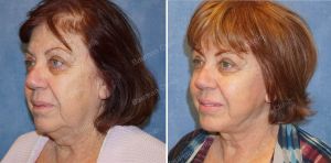 Căng da mặt nữ 68 tuổi người Mỹ - case 14