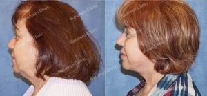 Căng da mặt nữ 68 tuổi người Mỹ - case 14