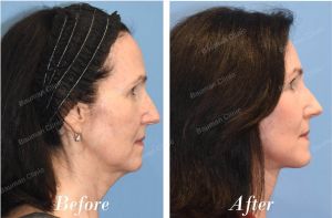 Căng da mặt, khách hàng Mỹ - case 15