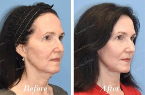 Căng da mặt, khách hàng Mỹ - case 15