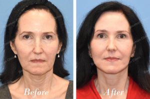 Căng da mặt, khách hàng Mỹ - case 15