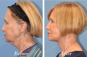 Căng da mặt, khách nữ người Mỹ - case 16