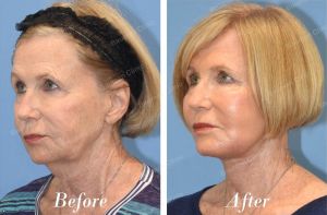 Căng da mặt, khách nữ người Mỹ - case 16