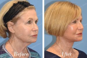 Căng da mặt, khách nữ người Mỹ - case 16