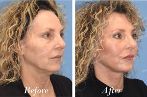 Căng da mặt, khách nữ người Mỹ - case 17