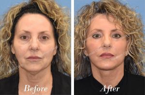 Căng da mặt, khách nữ người Mỹ - case 17