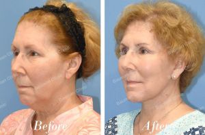 Căng da mặt trẻ lại 10 tuổi - case 19