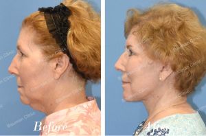 Căng da mặt trẻ lại 10 tuổi - case 19