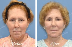 Căng da mặt trẻ lại 10 tuổi - case 19