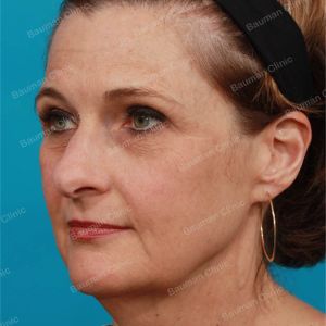 Căng da mặt, nữ 55 tuổi người Mỹ - case 2