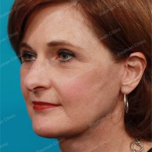 Căng da mặt, nữ 55 tuổi người Mỹ - case 2