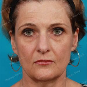 Căng da mặt, nữ 55 tuổi người Mỹ - case 2