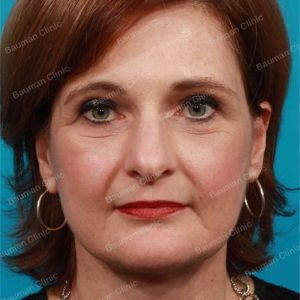 Căng da mặt, nữ 55 tuổi người Mỹ - case 2