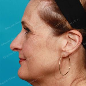 Căng da mặt, nữ 55 tuổi người Mỹ - case 2