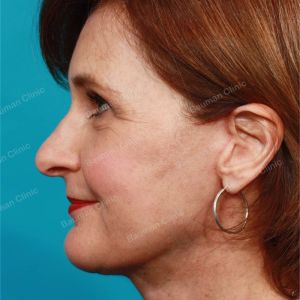 Căng da mặt, nữ 55 tuổi người Mỹ - case 2