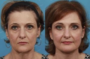 Căng da mặt, nữ 55 tuổi người Mỹ - case 2