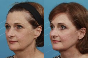 Căng da mặt, nữ 55 tuổi người Mỹ - case 2