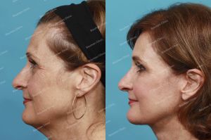 Căng da mặt, nữ 55 tuổi người Mỹ - case 2