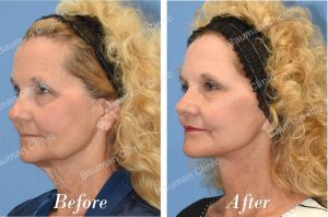 Căng da mặt khách hàng Mỹ - case 21