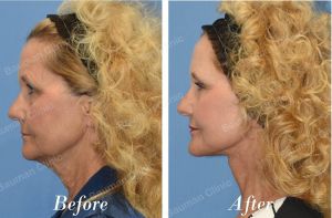 Căng da mặt khách hàng Mỹ - case 21