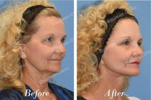 Căng da mặt khách hàng Mỹ - case 21