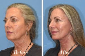 Căng da mặt - case 22