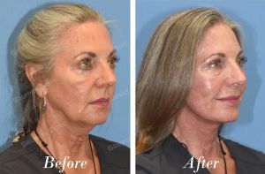 Căng da mặt - case 22