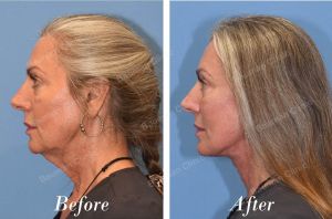 Căng da mặt - case 22