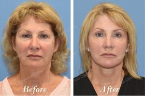 Căng da mặt trẻ lại 10 tuổi, khách hàng Mỹ - Case 23