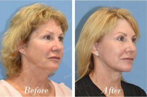 Căng da mặt trẻ lại 10 tuổi, khách hàng Mỹ - Case 23