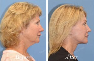 Căng da mặt trẻ lại 10 tuổi, khách hàng Mỹ - Case 23