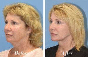 Căng da mặt trẻ lại 10 tuổi, khách hàng Mỹ - Case 23