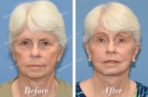 Căng da mặt - case 24