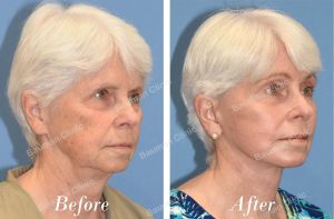 Căng da mặt - case 24