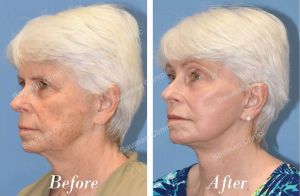 Căng da mặt - case 24