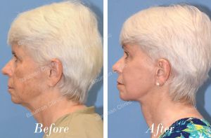 Căng da mặt - case 24