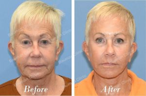 Chỉnh sửa căng da mặt - case 25