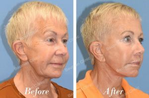 Chỉnh sửa căng da mặt - case 25