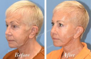 Chỉnh sửa căng da mặt - case 25