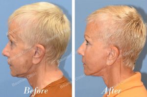 Chỉnh sửa căng da mặt - case 25