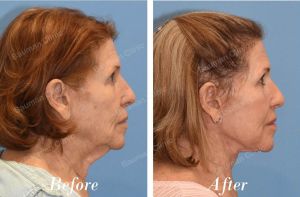 Kết quả 6 tháng sau căng da mặt - case 26