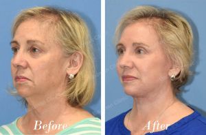 Căng da mặt sau 3 tháng trẻ ra 10 tuổi - case 27