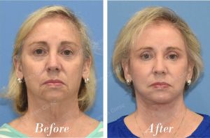 Căng da mặt sau 3 tháng trẻ ra 10 tuổi - case 27