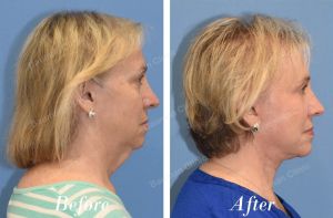 Căng da mặt sau 3 tháng trẻ ra 10 tuổi - case 27