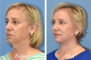 Căng da mặt sau 3 tháng trẻ ra 10 tuổi - case 27