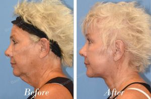 Căng da mặt khắc phục thừng cổ - case 28