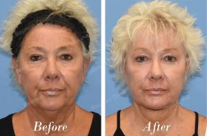 Căng da mặt khắc phục thừng cổ - case 28