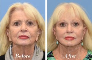 Căng da mặt U70 quay lại U60 - case 29